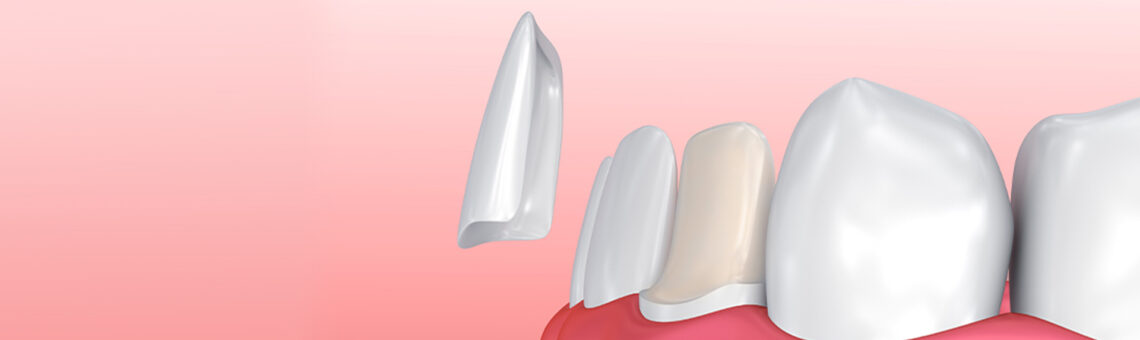 The Impressive Dental Transformation That Veneers Can Give You