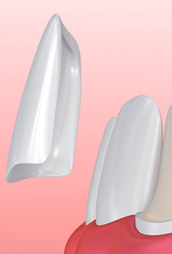 The Impressive Dental Transformation That Veneers Can Give You