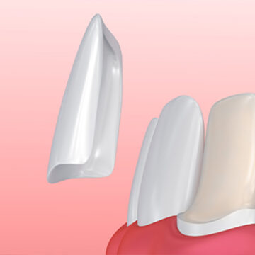 The Impressive Dental Transformation That Veneers Can Give You