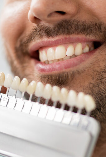 5 Vital Things You Need to Know About Dental Veneers in Pleasant Hill, CA