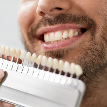 5 Vital Things You Need to Know About Dental Veneers in Pleasant Hill, CA