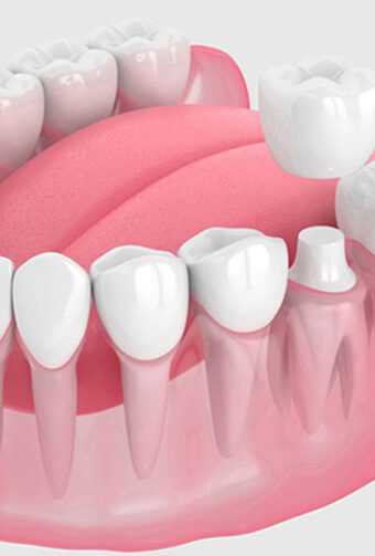 What Type of Tooth Crown Lasts the Longest?